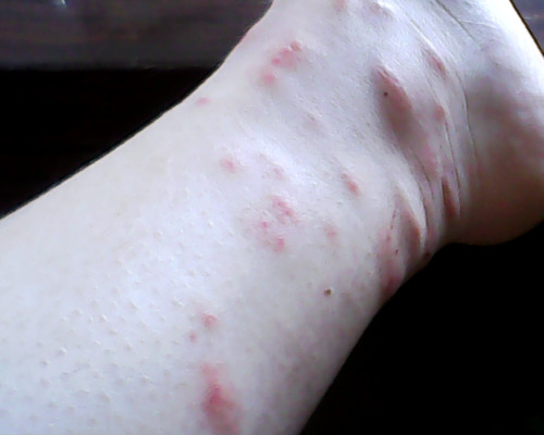 皮膚過敏了怎么辦？這可不是小事