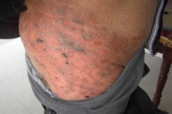 帶狀皰疹怎么治療 西藥治療帶狀皰疹的方法