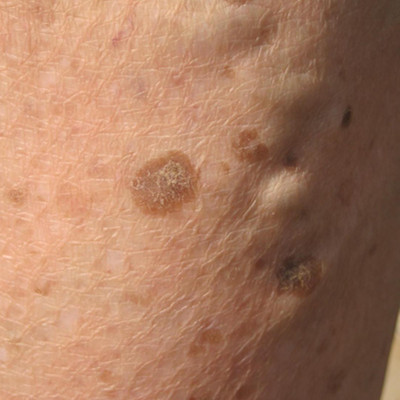 如何治老年斑  你學(xué)會了嗎