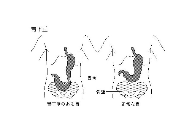 胃下垂病因和最佳的胃下垂治療方法