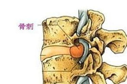 骨刺到底是不是病，治療骨刺的偏方