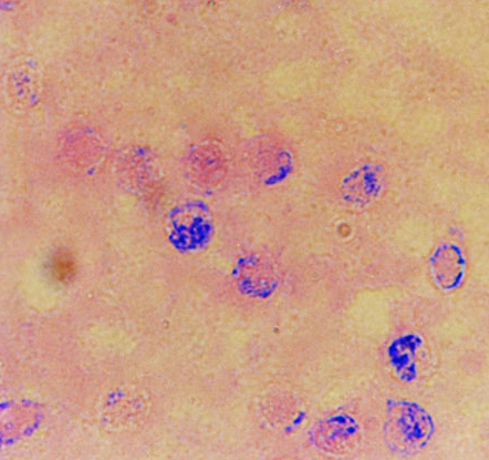 丹毒的癥狀  一般出現(xiàn)在小腿、臉部