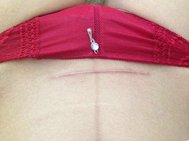 怎樣去疤痕 抓傷如何護(hù)理才不留疤痕