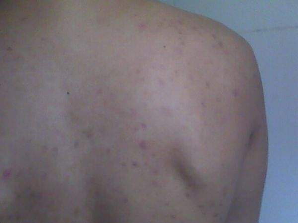 年輕人糾結(jié)背部長痘的原因