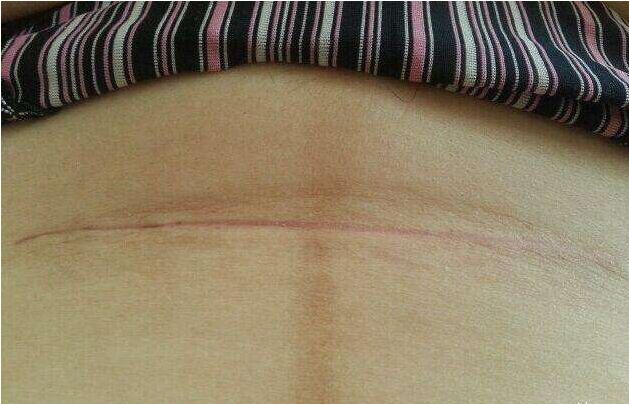 怎樣去疤痕 抓傷如何護理才不留疤痕