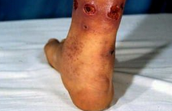 丹毒的癥狀  一般出現(xiàn)在小腿、臉部