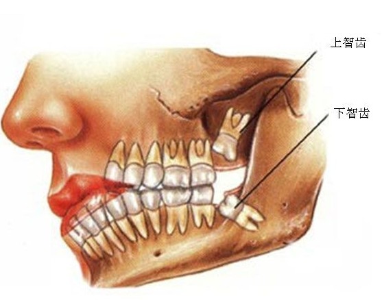 智齒發(fā)炎 注重口腔衛(wèi)生問題