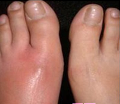 丹毒的癥狀  一般出現(xiàn)在小腿、臉部