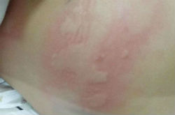 蕁麻疹的癥狀 主要有以下六種