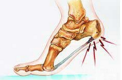 跟骨骨膜炎患者如何治療更有效