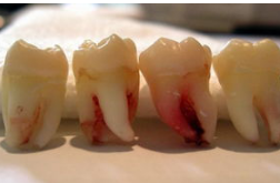 智齒發(fā)炎 注重口腔衛(wèi)生問題