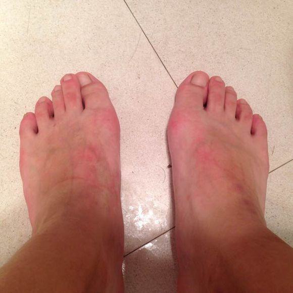 痛風(fēng)是什么？5大治療痛風(fēng)偏方獻(xiàn)給你