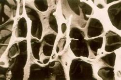 青少年骨質(zhì)疏松吃什么能更快康復(fù)