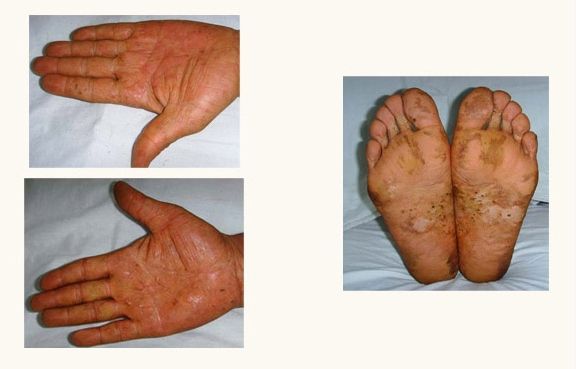 手足癬日常護(hù)理措施和治療工作大全