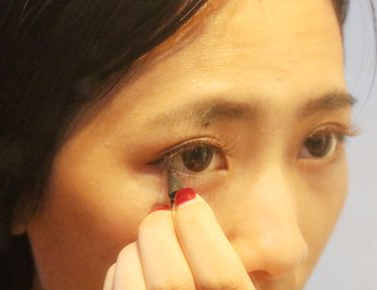 女性臉上長斑是什么原因及正確的治療方式