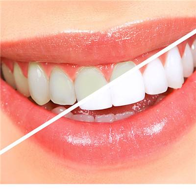 愛美的朋友不要錯過，怎么讓牙齒變白