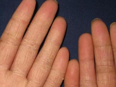 手足癬日常護理措施和治療工作大全