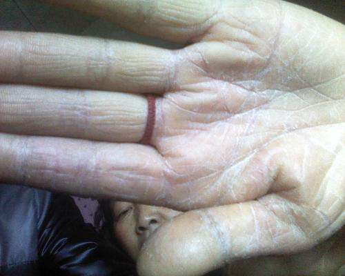 冬天手脫皮是怎么回事 這些方法可以幫助你