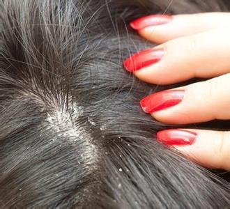 如何快速去除頭皮屑 對(duì)頭皮屑3大誤區(qū)