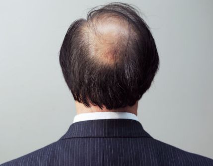 男性防止脫發(fā)的方法 這幾招不錯(cuò)