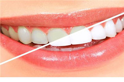 愛美的朋友不要錯(cuò)過，怎么讓牙齒變白