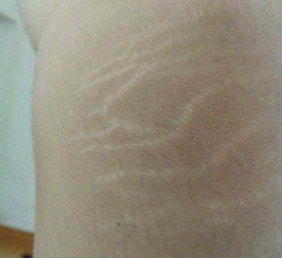 愛美女生關(guān)注的生長紋怎么去除