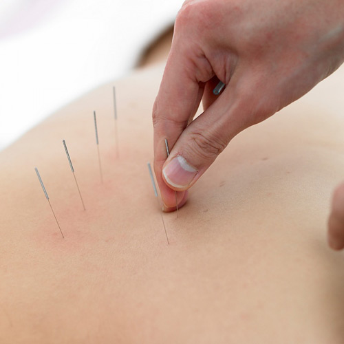 針灸減肥有副作用嗎 研究表明存在副作用