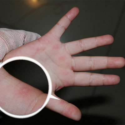 手足口病防治知識(shí)與注意事項(xiàng)