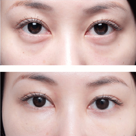 怎么治療眼袋成了當(dāng)下年輕人的困擾