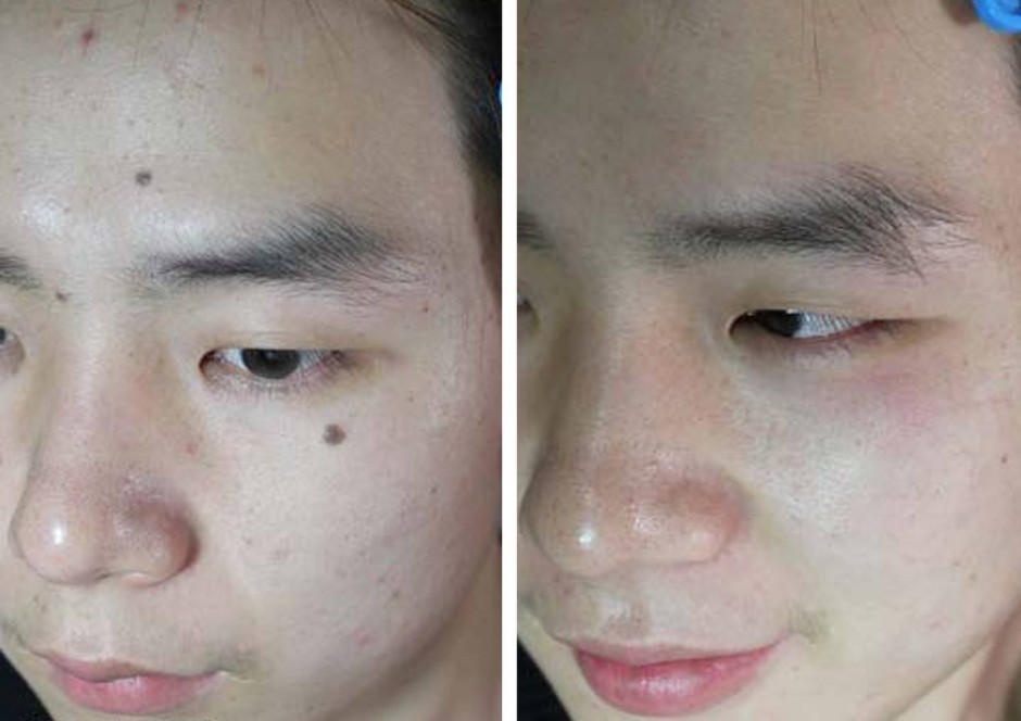 點(diǎn)痣后的注意事項(xiàng)須知 五要點(diǎn)需做好