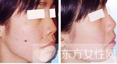 點(diǎn)痣后的注意事項(xiàng)須知 五要點(diǎn)需做好