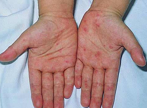 手足口病防治知識(shí)與注意事項(xiàng)