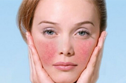 面部紅血絲怎么改善 教你保養(yǎng)好方法