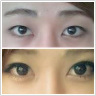 做雙眼皮的后遺癥 會留下疤痕