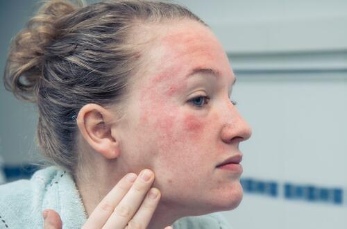 治療皮膚過敏偏方   五種偏方有奇效