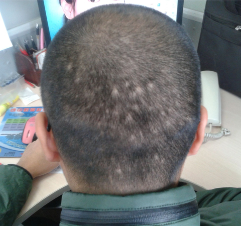 影響形象 斑禿最好的治療方法介紹