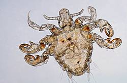 虱子咬的癥狀有哪些 怎樣去除虱子