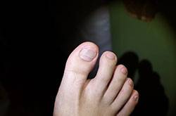 治療灰指甲偏方有哪些 注意事項不可忘