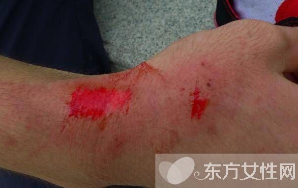 擦傷怎么自行處理 不同類型疤痕的治療方法