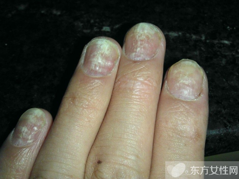 治療灰指甲偏方有哪些 注意事項不可忘