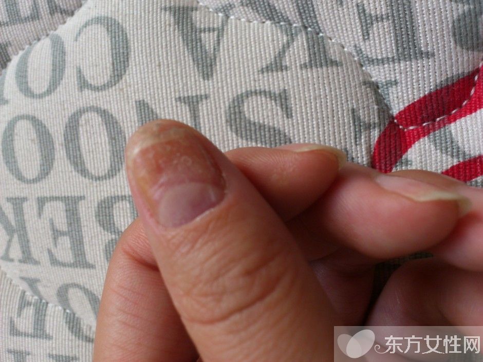 灰指甲會傳染嗎 灰指甲的護(hù)理方法