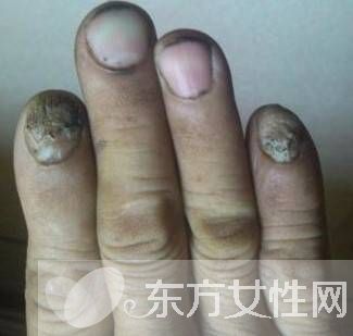 治療灰指甲偏方有哪些 注意事項不可忘
