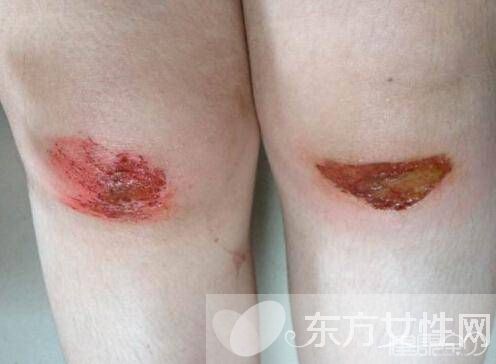 擦傷怎么自行處理 不同類型疤痕的治療方法