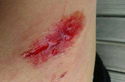 擦傷怎么自行處理 不同類型疤痕的治療方法