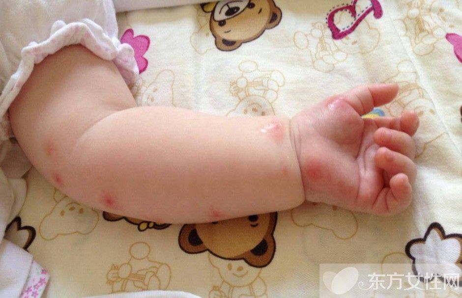 止癢的方法有哪些 常見的4大過(guò)敏源