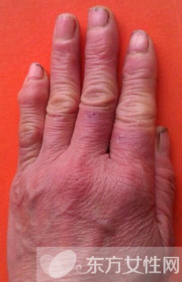 怎么治凍瘡 幾招教你怎樣預(yù)防凍瘡