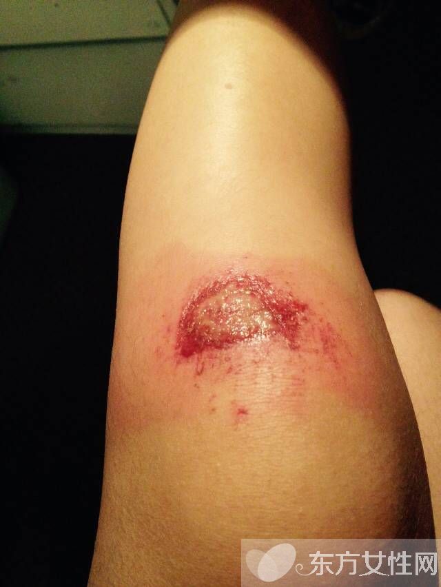 擦傷怎么自行處理 不同類型疤痕的治療方法