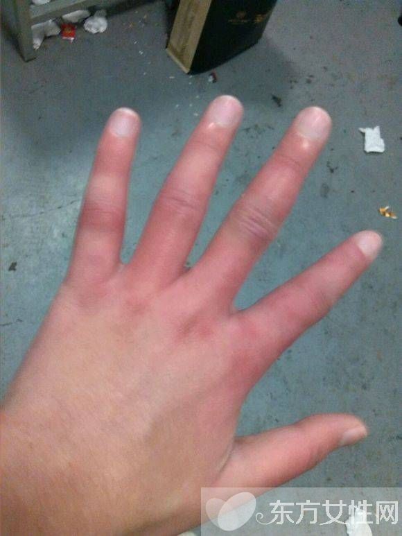 冬天凍傷怎么辦 凍傷兩大緊急處理辦法