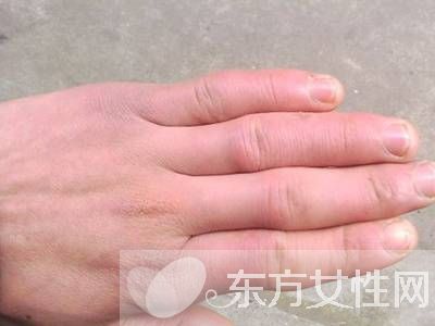 怎么治凍瘡 幾招教你怎樣預(yù)防凍瘡