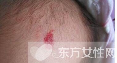 紅胎記是什么 胎記怎么去除